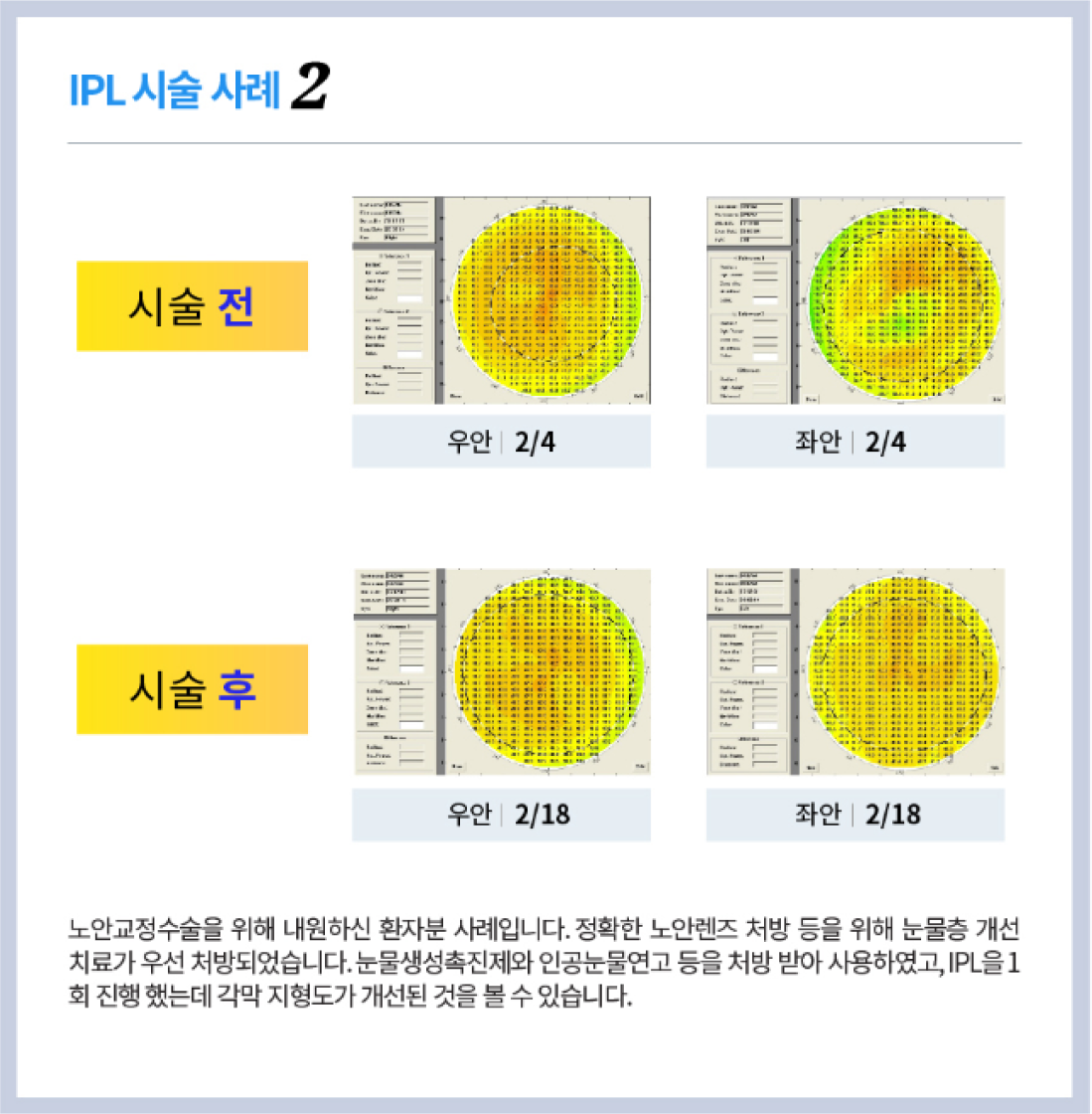 시술사례2