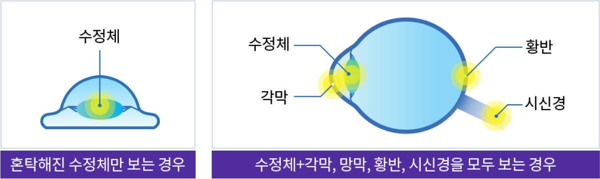 혼탁해진 수정체만 보는 경우 / 수정체 + 각막 , 망막, 황반, 시신경을 모두 보는경우
