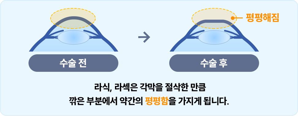 각막실질, 레이저, 각막상피