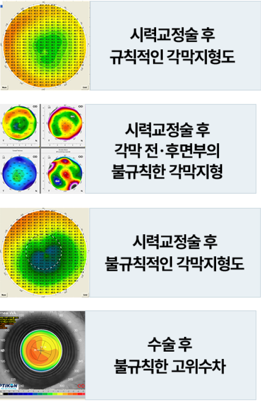 각막표면이 균일하지않아 번짐현상이 있을수있습니다.