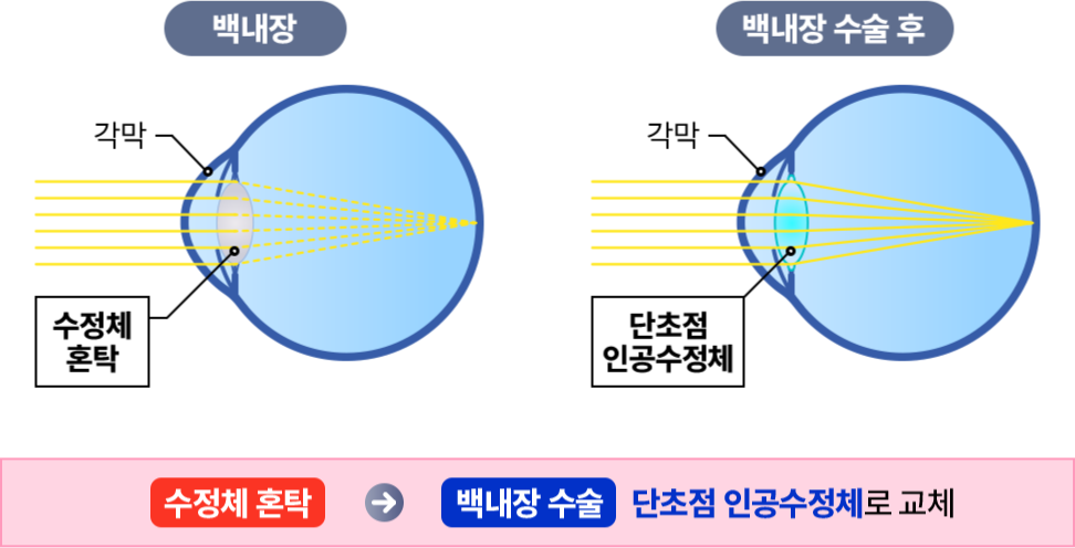 각막실질, 레이저, 각막상피