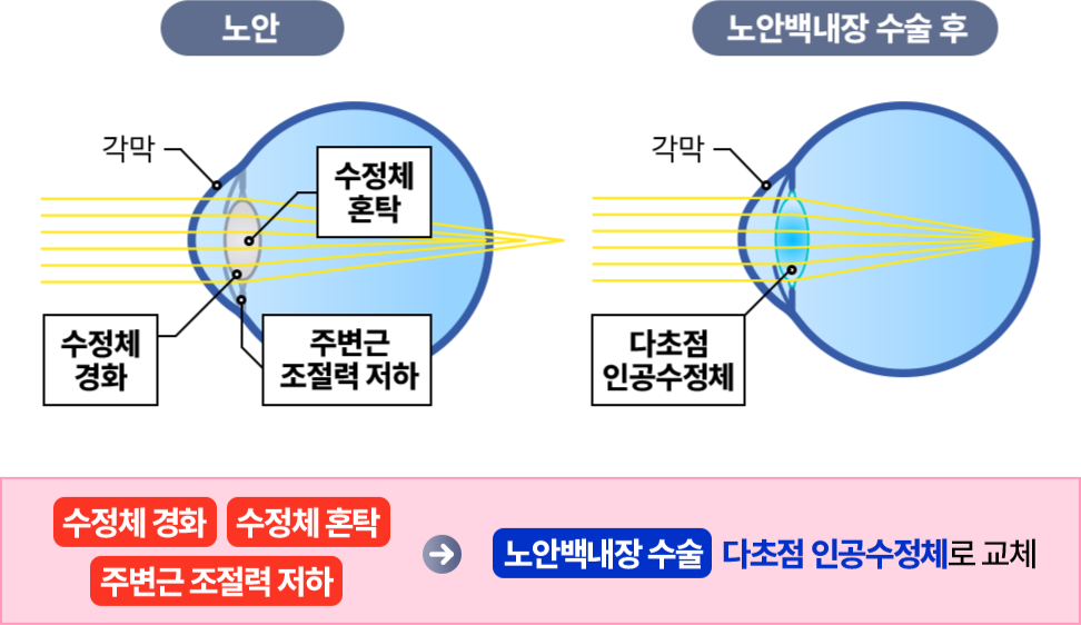 각막실질, 레이저, 각막상피