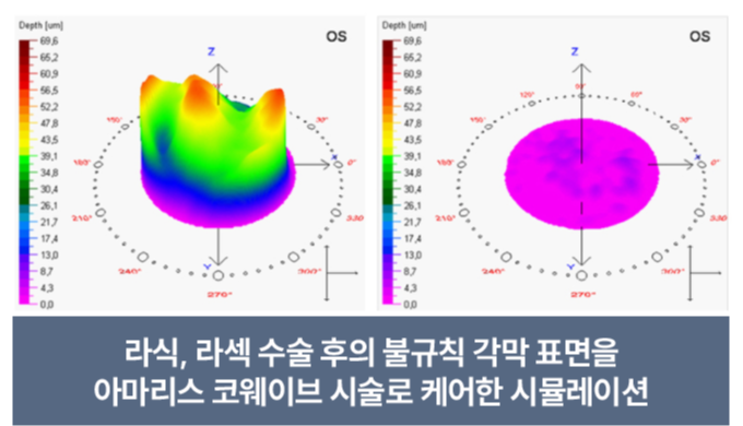 라식. 라섹 수술 후 불규칙한 표면 케어
