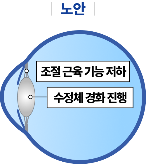 수정체 혼탁