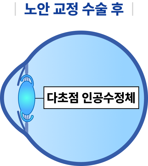인공 수정체