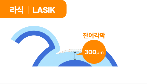 라식 | LASIK