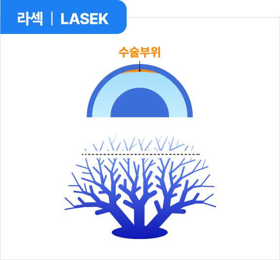 라섹 | LASEK