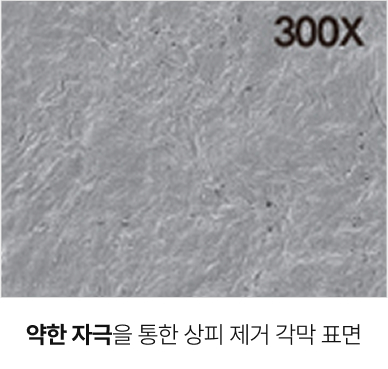 약한 자극을 통한 상피 제거 각막 표면