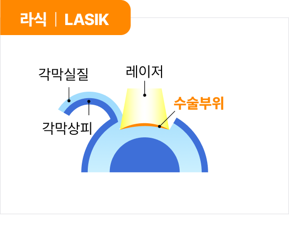 라식 | LASIC
